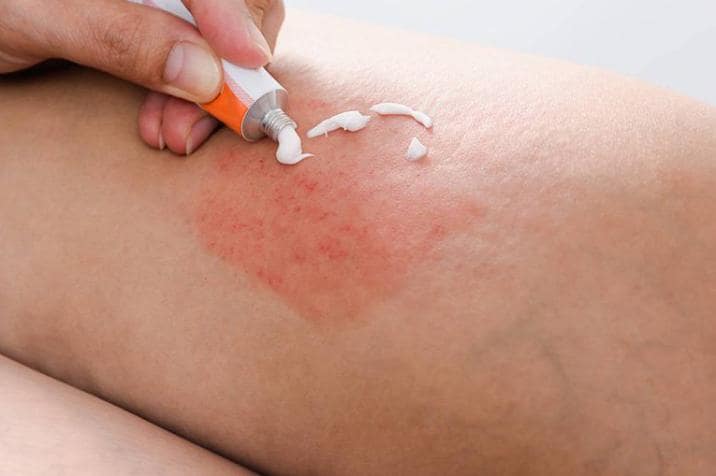 Cách điều trị bệnh nấm mèo ở người